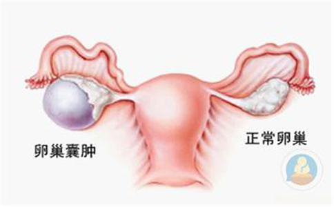 卵巢囊腫，抱腿壓涌泉穴，給你愛心呵護(hù)